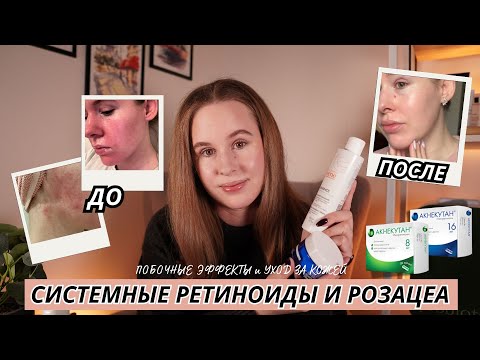 ЛЕЧЕНИЕ РОЗАЦЕА СИСТЕМНЫМИ РЕТИНОИДАМИ (АКНЕКУТАН) | МОЙ ОПЫТ