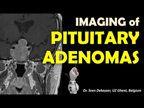 Imaging of Pituitary Adenomas