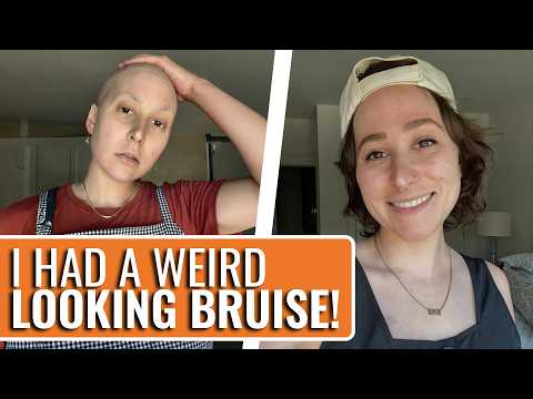 Painless Bruise Was Actually Sarcoma Cancer! - Sophie | Ewing Sarcoma | The Patient Story