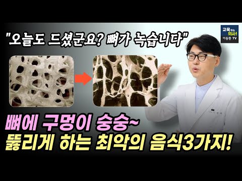 뼈를 녹이는 최악의 음식. 나도 모르게 매일 먹는 이 음식이 골다공증을 만듭니다. 골감소증.