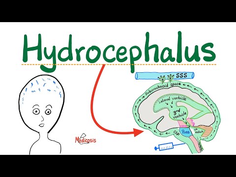 Hydrocephalus -Communicating, Noncommunicating Hydrocephalus,Normal Pressure Hydrocephalus,Ex vaccuo