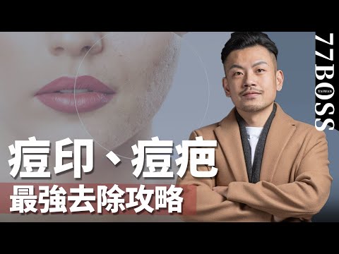 痘疤、痘斑怎麼消？最強攻略！【77老大】
