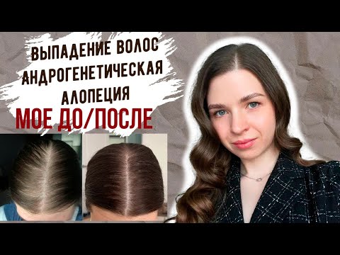 ВЫПАДЕНИЕ ВОЛОС |  ДО и ПОСЛЕ | Андрогенетическая алопеция #выпадениеволос #алопеция
