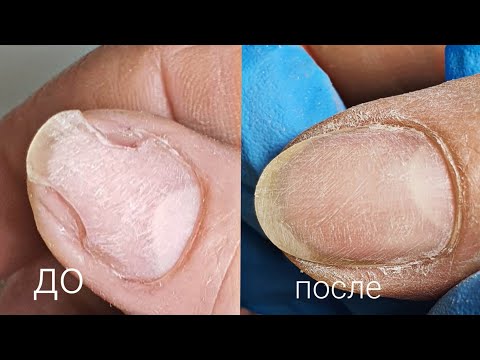 Решение проблемы с онихолизисом