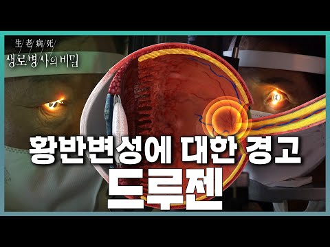 진행 빠른 황반변성 조기 발견의 열쇠, 드루젠 | KBS 240228 방송