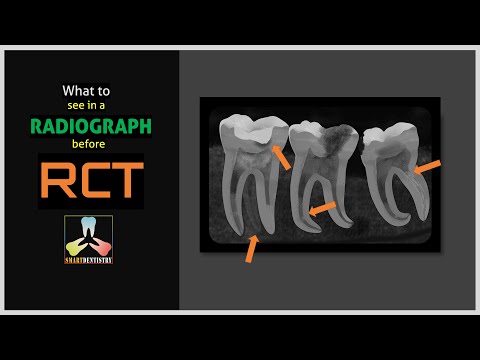 What to see in a radiograph before RCT