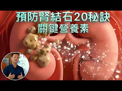 預防腎結石20個祕訣,自然療法,柏格醫生 Dr Berg