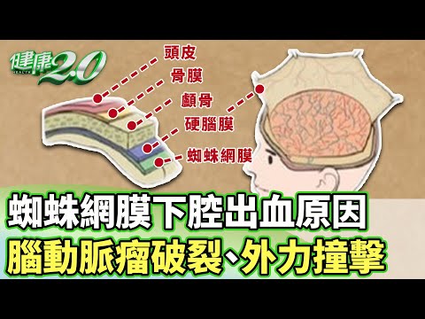 蜘蛛網膜下腔出血原因！腦動脈瘤破裂、外力撞擊  【健康2.0 分段】 @tvbshealth20   EP3004-1 20250406 #鄭凱云 #丁賢偉 #鄔定宇 #吳宏乾 #陳麗華