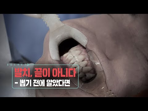 📌방송 하이라이트📌 발치, 끝이 아니다 - 뽑기 전에 알았다면 (KBS 20230208 방송)