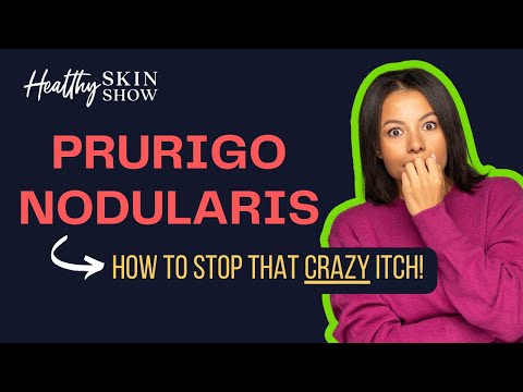What is PRURIGO NODULARIS: Treatment to STOP the CRAZY ITCH | Shawn Kwatra