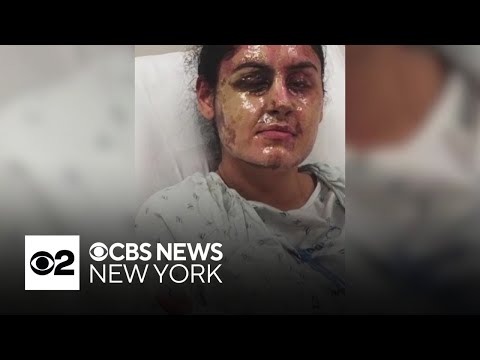 Prosecutors charged a second person in acid attack of Long Island college student