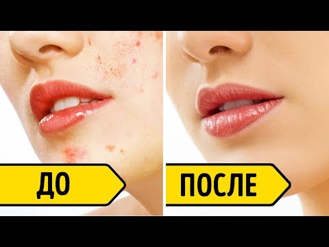 Как Избавиться от Следов После Акне за 3 Дня