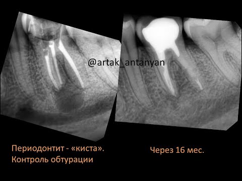 Как заживает «киста» зуба? Удаление кисты зуба. Зуб имплант. Периодонтит. Гайморит. Виниры