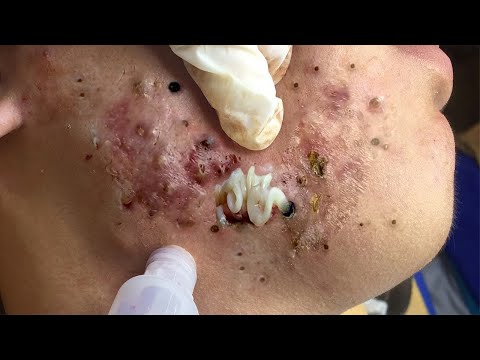 𝑪𝒚𝒔𝒕𝒊𝒄 𝑨𝒄𝒏𝒆 𝑹𝒆𝒎𝒐𝒗𝒂𝒍 & 𝑰𝒏𝒇𝒍𝒂𝒎𝒎𝒂𝒕𝒐𝒓𝒚 𝑨𝒄𝒏𝒆 #𝟗𝟖𝟎𝟑