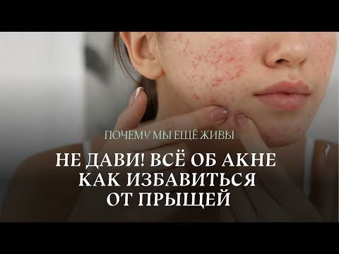 Человечество против прыщей: от припарок к ретиноидам | Почему мы еще живы