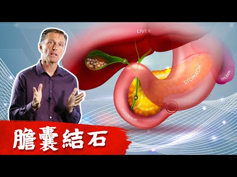 (結石1) 膽結石真正原因,不是吃脂肪造成!!柏格醫生
