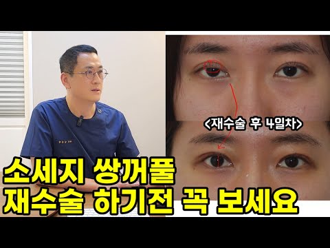 소세지 쌍꺼풀 재수술에 대한 솔직한 이야기(후기,부작용)