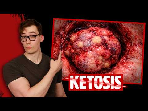Ketosis (Fasting/Ketogenic Diet) accelerates Cancer Growth - New Study