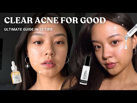 How to Get Rid of Acne Without Going Broke | ULTIMATE CLEAR SKIN GUIDE