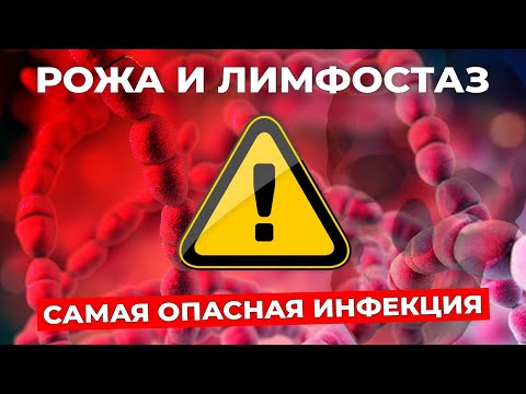 РОЖА: почему возникает при отеке и чем рискует пациент с лимфостазом #лимфостаз #рмж #ракгруди