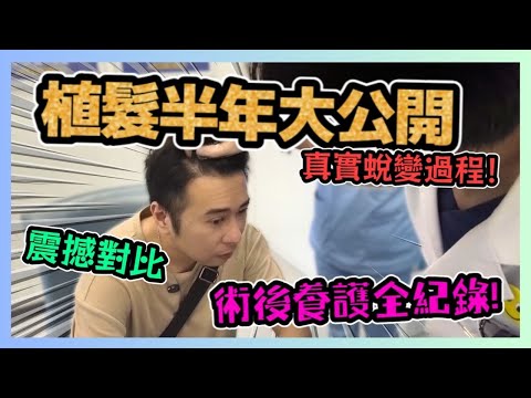 植髮半年大公開 術後養護全紀錄💇‍♂️！從稀疏到濃密 震撼對比🌟！大麥植髮 粉絲專屬福利🛎️！