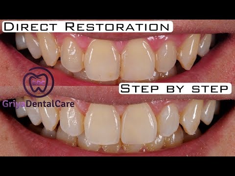 Penambalan Gigi Depan Dengan Resin Komposit Kelas IV / Direct Restoration Composite Class IV