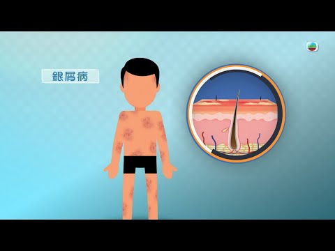 TVB最強生命線|銀屑病 (繁 / 簡字幕)|醫療|治療|中醫|無綫新聞|TVB News
