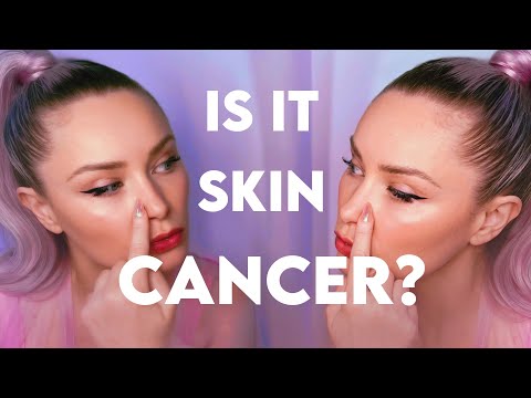 I Saw the Skin Cancer Signs and my Dermatologist Didn’t 😖