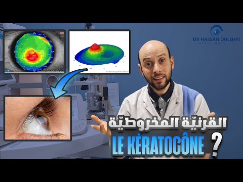 Le Kératocône                                                                      القرنية المخروطية