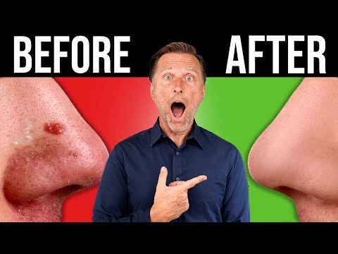 The BEST BLACKHEAD & Acne Remedy in the World (One-Time Fix)