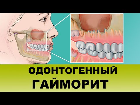 ОДОНТОГЕННЫЙ ГАЙМОРИТ