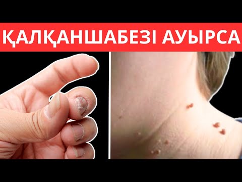 ҚАЛҚАНША БЕЗІ алғашқы 5 белгісі. Қалқанша без аурулары белгілері