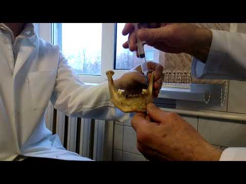 Ментальная анестезия