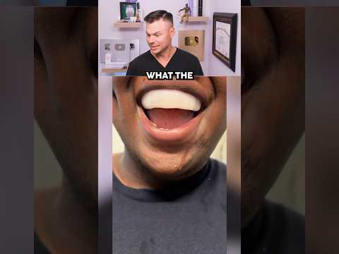 Results Of HOMEMADE Veneers Are NOT Good! 😭🦷