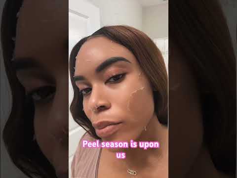 #vipeel #chemicalpeel #skinreset  Love the VI peel…. Radiant healthy skin in just 7 days 🥰