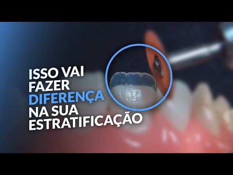 ESTRATIFICAÇÃO EM DENTES CLAREADOS