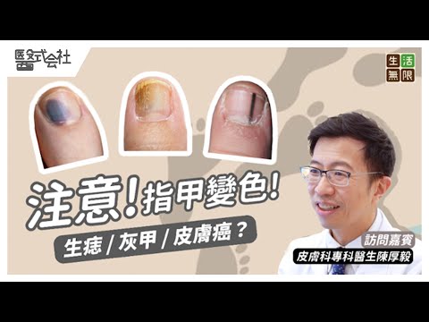 注意！指甲變色是否灰甲？還是皮膚癌先兆？｜#醫式会社 (第5集) #生活無限 #灰甲 #甲癬  #香港腳 #腳癬 #指甲變色 #脚趾 #灰甲脫落 #灰甲藥水 #podcast
