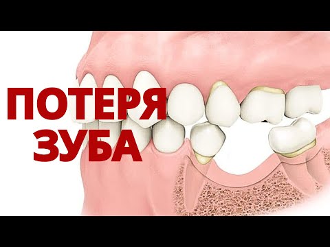 Tooth loss | What should I do if my teeth are tilted? Will braces help?