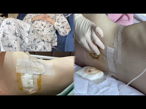 Cancer Patient Vlog | Failed Procedure, Blood and Fluid Continue to Leak from Spine 😞 | Bone Meta...