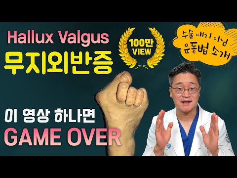 엄지가 살짝이라도 튀어나오신 분이라면 필수 시청 영상!  (무지외반증, 원인, 예방, 치료, 운동 방법 등 총정리)
