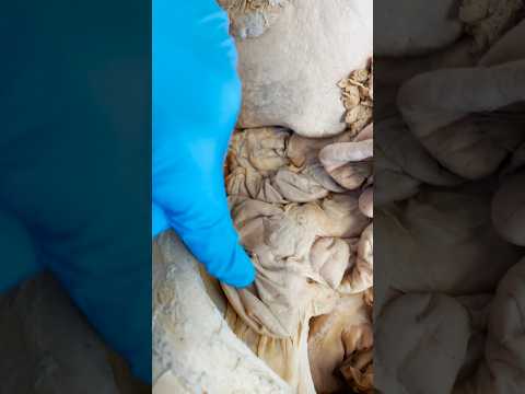 Where Your Appendix is Really Located