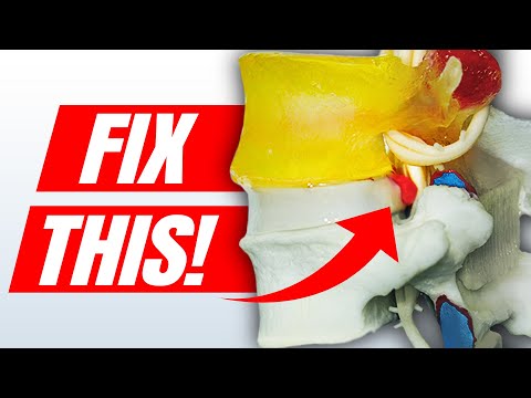 How to Fix a Bulging Disc in Your Lower Back