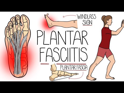 Plantar Fasciitis Explained Clearly (Including Treatment Options!)