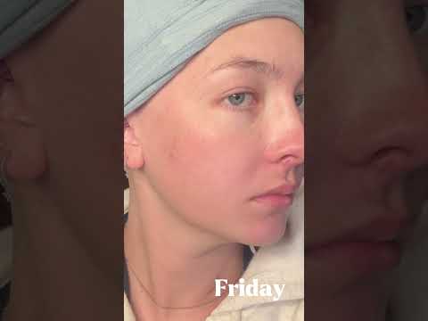 What 5 days straight of chemotherapy will do to your face #cancer #chemosideeffects #lifewithcancer