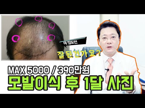 모발이식 한달 후 이거 잘 못 된거 아닌가요? 모발이 별로 없어 보입니다.