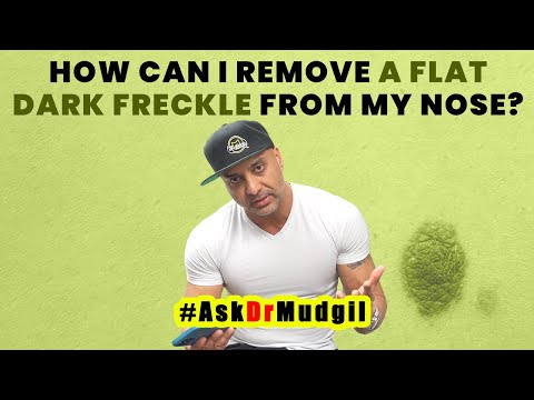 HOW CAN I REMOVE A FLAT DARK FRECKLE FROM MY NOSE?