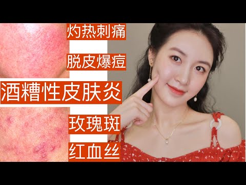 【求医不如求己】酒糟性皮肤炎玫瑰痤疮患者经验分享