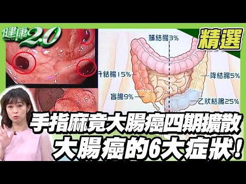 手指麻竟是大腸癌四期擴散 大腸癌的6大症狀! 年輕糖尿病患者當心大腸癌 好發期提前5年報到【健康2.0精選】