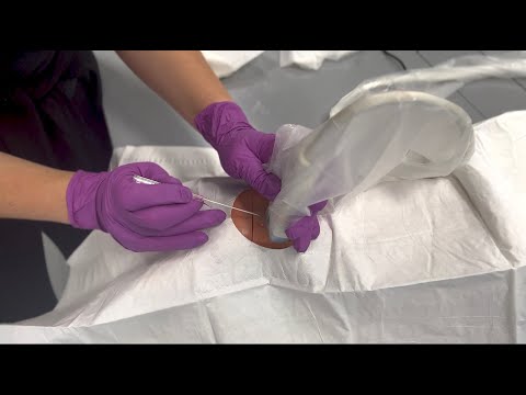 Ultrasound-Guided Arterial Line Placement