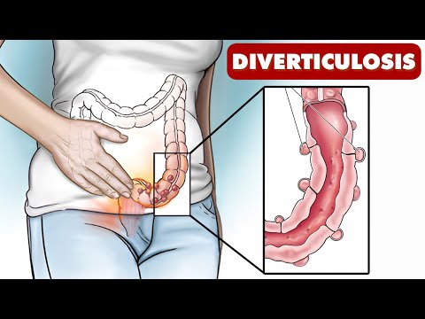 Understanding Diverticulosis and Diverticulitis-Doctor Explains